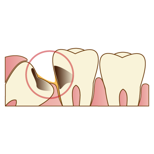 親知らずで虫歯になっている歯のイラスト
