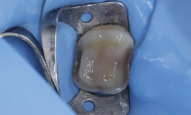 セラミック治療（e-max CAD)Before