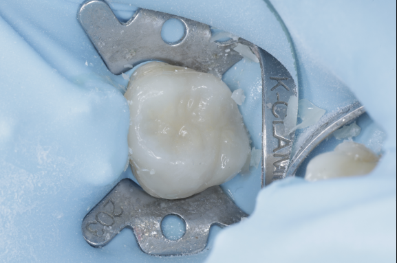 セラミック治療（e-max CAD)症例治療経過