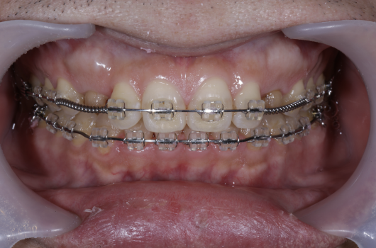歯列矯正とインプラント治療症例①経過