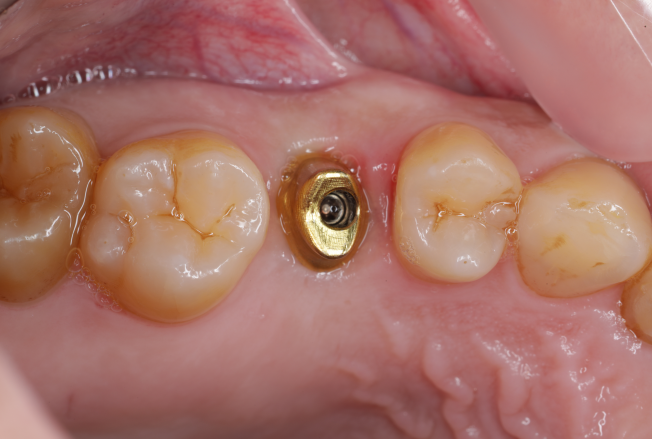 インプラント治療症例③インプラント埋入