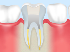 根管治療ステップ5