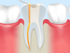 根管治療ステップ4