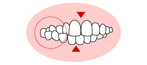 交叉咬合（こうさこうごう）のイラスト
