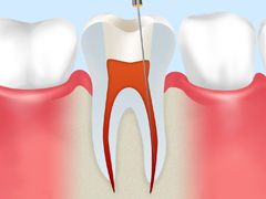 根管治療ステップ2