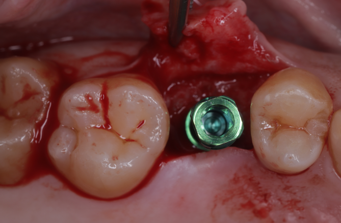 インプラント治療症例③インプラント埋入