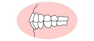 上下顎前突（じょうげがくぜんとつ）のイラスト
