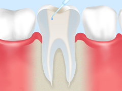 根管治療ステップ3