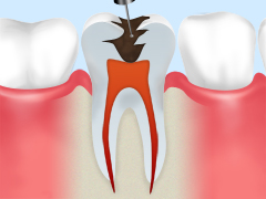 根管治療ステップ1