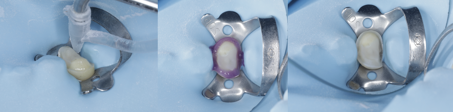 セラミック治療（e-max CAD)治療経過