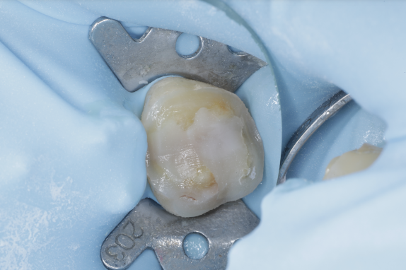 セラミック治療（e-max CAD)症例治療経過